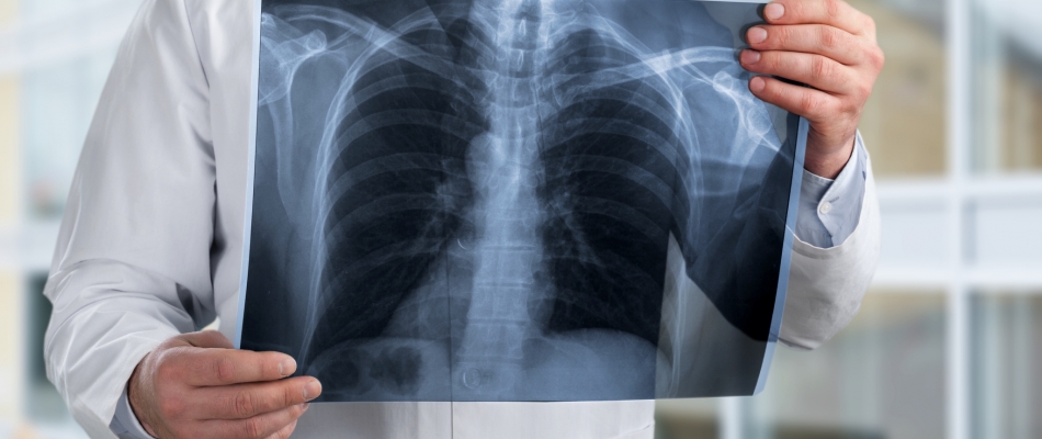 5 idées reçues sur le cancer du poumon - Minizap Nord-Isère
