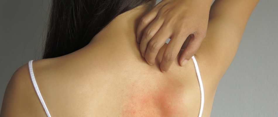 Survivre avec un eczema l'été - Minizap Annecy