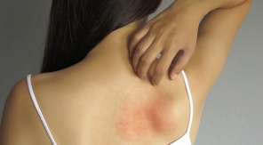 Survivre avec un eczema l'été
