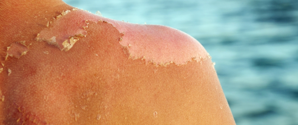 L'empoisonnement au soleil, les symptômes qui doivent alerter - Minizap Grenoble