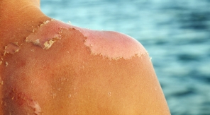 L'empoisonnement au soleil, les symptômes qui doivent alerter