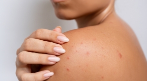 Boutons de chaleur, comment s'en débarrasser ?