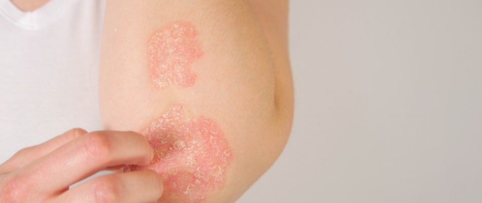 Psoriasis : une piste génétique pour révolutionner le traitement - Minizap Chambery