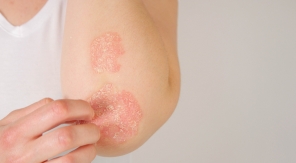 Psoriasis : une piste génétique pour révolutionner le traitement